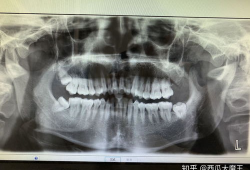 拔智齿视频全真实过程,拔智齿的真实手术过程